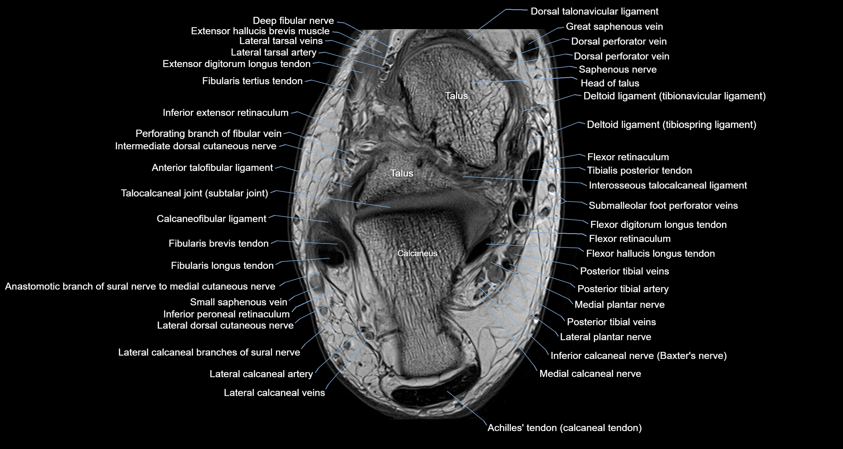 Ankle axial anatomy 3T MRI images -img-10001-00022.webp
